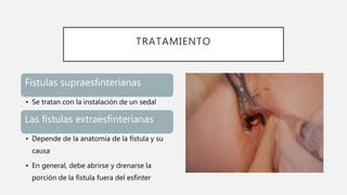 TRATAMIENTO
Fistulas supraesfinterianas
• Se tratan con la instalación de un sedal
Las fístulas extraesfinterianas
• Depende de la anatomía de la fístula y su
causa
• En general, debe abrirse y drenarse la
porción de la fístula fuera del esfínter
 