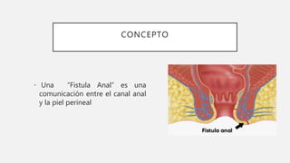 CONCEPTO
• Una “Fistula Anal” es una
comunicación entre el canal anal
y la piel perineal
 