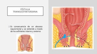 FÍSTULA
TRANSESFINTERIANA
 Es consecuencia de un absceso
isquiorrectal y se extiende a través
de los esfínteres interno y externo
 