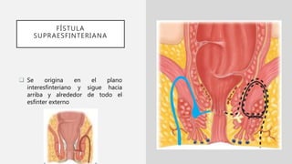 FÍSTULA
SUPRAESFINTERIANA
 Se origina en el plano
interesfinteriano y sigue hacia
arriba y alrededor de todo el
esfínter externo
 
