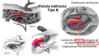 Fístula carótido cavernosa - revision.pptx