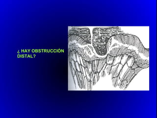 ¿ HAY OBSTRUCCIÓN
DISTAL?
 