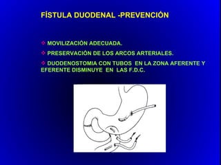 FÍSTULA DUODENAL -PREVENCIÓN


 MOVILIZACIÓN ADECUADA.
 PRESERVACIÓN DE LOS ARCOS ARTERIALES.
 DUODENOSTOMIA CON TUBOS EN LA ZONA AFERENTE Y
EFERENTE DISMINUYE EN LAS F.D.C.
 