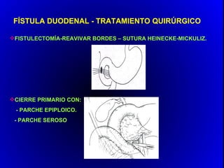 FÍSTULA DUODENAL - TRATAMIENTO QUIRÚRGICO

FISTULECTOMÍA-REAVIVAR BORDES – SUTURA HEINECKE-MICKULIZ.




CIERRE PRIMARIO CON:
 - PARCHE EPIPLOICO.
 - PARCHE SEROSO
 