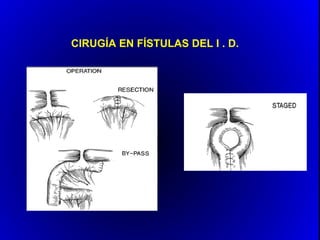 CIRUGÍA EN FÍSTULAS DEL I . D.
 