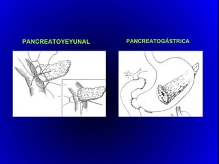 PANCREATOYEYUNAL   PANCREATOGÁSTRICA
 