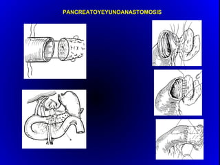 PANCREATOYEYUNOANASTOMOSIS
 