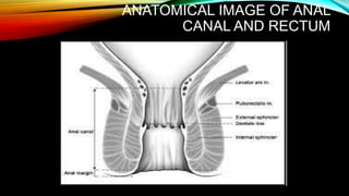 Fistula in Ano, - conceptual review--simple slides for learners | PPTX
