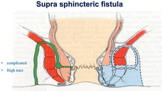 Fistula in ano by Dr.Abhishek S L | PDF