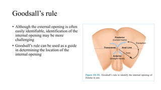 Goodsall’s rule
• Although the external opening is often
easily identifiable, identification of the
internal opening may be more
challenging
• Goodsall’s rule can be used as a guide
in determining the location of the
internal opening
 