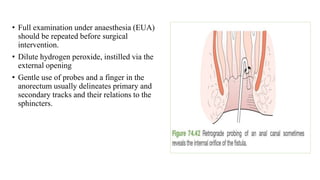 • Full examination under anaesthesia (EUA)
should be repeated before surgical
intervention.
• Dilute hydrogen peroxide, instilled via the
external opening
• Gentle use of probes and a finger in the
anorectum usually delineates primary and
secondary tracks and their relations to the
sphincters.
 