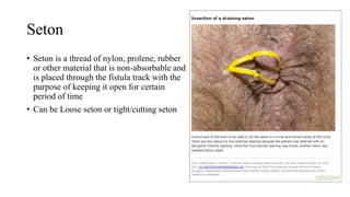 Seton
• Seton is a thread of nylon, prolene, rubber
or other material that is non-absorbable and
is placed through the fistula track with the
purpose of keeping it open for certain
period of time
• Can be Loose seton or tight/cutting seton
 
