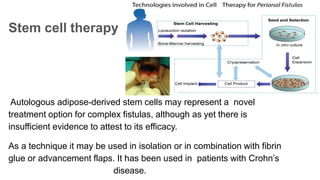 Stem cell therapy
Autologous adipose-derived stem cells may represent a novel
treatment option for complex fistulas, although as yet there is
insufficient evidence to attest to its efficacy.
As a technique it may be used in isolation or in combination with fibrin
glue or advancement flaps. It has been used in patients with Crohn’s
disease.
 