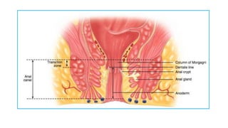 Fistula in ano | PPTX