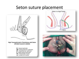 Fistula in ANO | PPTX