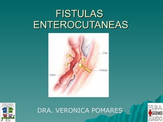FISTULAS  ENTEROCUTANEAS DRA. VERONICA POMARES 