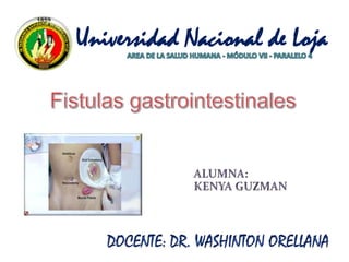 Universidad Nacional de Loja AREA DE LA SALUD HUMANA - MÓDULO VII - PARALELO 4 Fistulas gastrointestinales  ALUMNA: KENYA GUZMAN  DOCENTE: DR. WASHINTON ORELLANA  
