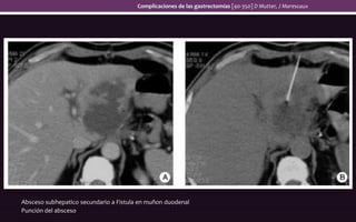 Absceso subhepatico secundario a Fistula en muñon duodenal
Punción del absceso
Complicaciones de las gastrectomías [40-350] D Mutter, J Marescaux
 