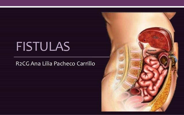 fistulas