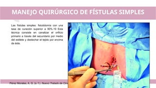 MANEJO QUIRÚRGICO DE FÍSTULAS SIMPLES
Las fístulas simples: fistulotomía con una
tasa de curación superior a 90%.19 Esta
técnica consiste en canalizar el orificio
primario a través del secundario por medio
del estilete y destechar el tejido por encima
de éste.
Pérez Morales, A. G. (s. f.). Nuevo Tratado de Cirugía General (1.a
ed., Vols. 1–2). Editorial El Manual Moderno.
 