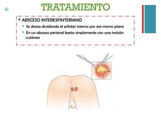 +
 ABSCESO INTERESFINTERIANO
 Se drena dividiendo el esfinter interno por ese mismo plano
 En un absceso perianal basta simplemente con una incisión
cutánea
 