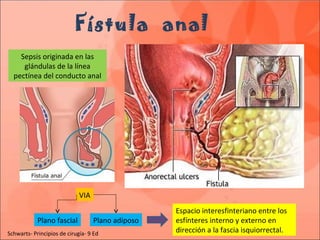 Fístula anal
Sepsis originada en las
glándulas de la línea
pectínea del conducto anal
VIA
Plano adiposoPlano fascial
Espacio interesfinteriano entre los
esfínteres interno y externo en
dirección a la fascia isquiorrectal.Schwarts- Principios de cirugía- 9 Ed
 