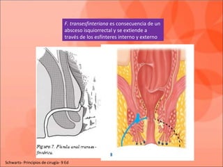 F. transesfinteriana es consecuencia de un
absceso isquiorrectal y se extiende a
través de los esfínteres interno y externo
Schwarts- Principios de cirugía- 9 Ed
 