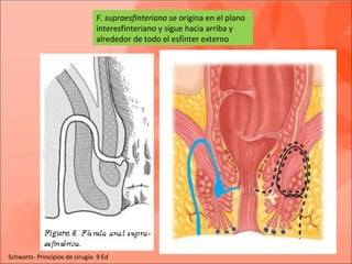 F. supraesfinteriana se origina en el plano
interesfinteriano y sigue hacia arriba y
alrededor de todo el esfínter externo
Schwarts- Principios de cirugía- 9 Ed
 