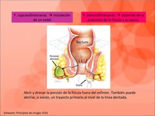 F. extraesfinterianas  depende de la
anatomía de la fístula y su causa.
F. supraesfinterianas  instalación
de un sedal
Abrir y drenar la porción de la fístula fuera del esfínter. También puede
abrirse, si existe, un trayecto primario al nivel de la línea dentada.
Schwarts- Principios de cirugía- 9 Ed
 