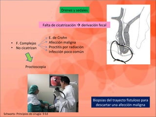 Drenes y sedales
Falta de cicatrización  derivación fecal
E. de Crohn
Afección maligna
Proctitis por radiación
Infección poco común
• F. Complejas
• No cicatrizan
Proctoscopia
Biopsias del trayecto fistuloso para
descartar una afección maligna
Schwarts- Principios de cirugía- 9 Ed
 