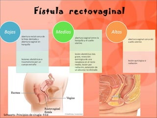Fístula rectovaginal
Schwarts- Principios de cirugía- 9 Ed
 