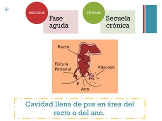 +
Cavidad llena de pus en área del
recto o del ano.
 