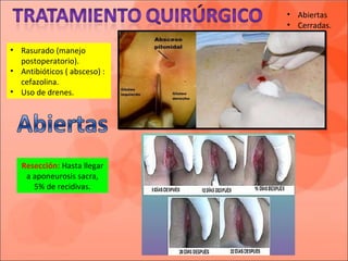 • Rasurado (manejo
postoperatorio).
• Antibióticos ( absceso) :
cefazolina.
• Uso de drenes.
• Abiertas
• Cerradas.
Resección: Hasta llegar
a aponeurosis sacra,
5% de recidivas.
 