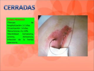 CIERRE PRIMARIO
•Tiempo de
hospitalización: 1-5 días.
•Cicatrización: 14 días.
•Recurrencia: 4 a 10%.
•Morbilidad: hematoma,
seroma, dehisencia,
infección de la herida
operatoria.
 