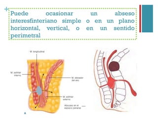+ Puede ocasionar un abseso
interesfinteriano simple o en un plano
horizontal, vertical, o en un sentido
perimetral
 