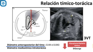 Relación tímico-torácica
Diámetro anteroposterior del timo : 0.44 ± 0.043
Diámetro mediastínico intratorácico
3VT
DiGeorge
Hipoplasia/Aplasia
tímica
 