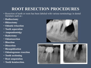 Tooth Hemisection Fistulative and corrective surgery | PPTX