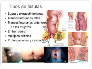 Paula coelho bbw nude Estilete pra fistula anal