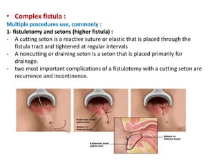 • Complex fistula :
Multiple procedures use, commonly :
1- fistulotomy and setons (higher fistula) :
- A cutting seton is a reactive suture or elastic that is placed through the
fistula tract and tightened at regular intervals
- A noncutting or draining seton is a seton that is placed primarily for
drainage.
- two most important complications of a fistulotomy with a cutting seton are
recurrence and incontinence.
 