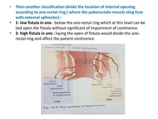 • Then another classification divide the location of internal opening
according to ano-rectal ring ( where the puborectalis muscle sling fuse
with external sphincter) :
• 1- low fistula in ano : below the ano-rectal ring which at this level can be
laid open the fistula without significant of impairment of continence.
• 2- high fistula in ano : laying the open of fistula would divide the ano-
rectal ring and affect the patient continence.
 