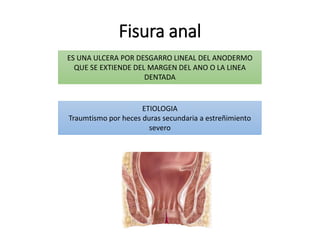 Fisura absceso | PPTX