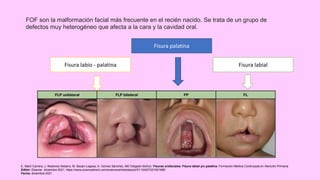 Labial Science tema: Fisura labio alveolo - palatina.pptx