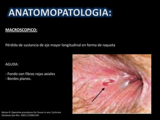 MACROSCOPICO:
Pérdida de sustancia de eje mayor longitudinal en forma de raqueta
AGUDA:
- Fondo con fibras rojas axiales
- Bordes planos.
Nelson R. Operative procedures for fissure in ano. Cochrane
Database Syst Rev. 2005;2:CD002199.
 