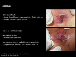 CRONICAS
-Ulcera profunda.
- Borde fibras blancas transversales; esfínter interno.
- Bordes, socavados y ulcerados.
Lesiones acompañantes :
-Papila hipertrófica
- Hemorroides centinela.
Son engrosamientos probablemente vinculados
a un grado leve de infección y edema linfático
Nelson R. Operative procedures for fissure in ano. Cochrane
Database Syst Rev. 2005;2:CD002199.
 
