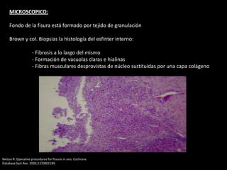 MICROSCOPICO:
Fondo de la fisura está formado por tejido de granulación
Brown y col. Biopsias la histología del esfínter interno:
- Fibrosis a lo largo del mismo
- Formación de vacuolas claras e hialinas
- Fibras musculares desprovistas de núcleo sustituidas por una capa colágeno
Nelson R. Operative procedures for fissure in ano. Cochrane
Database Syst Rev. 2005;2:CD002199.
 
