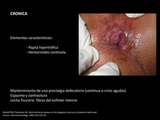 CRONICA
Elementos característicos:
- Papila hipertrófica
- Hemorroides centinela.
Mantenimiento de una proctalgia defecatoria (continua o crisis agudas)
Espasmo y contractura
Lecho fisurario fibras del esfínter interno
Madoff RD, Fleshman JW. AGA technical review on the diagnosis and care of patients with anal
fissure. Gastroenterology. 2003;124:235-45.
 