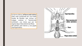 En forma clásica, la fisura anal crónica
(FAC) está constituida por una tríada
(tríada de Brodie), que incluye un
colgajo cutáneo o “hemorroide
centinela”, una úlcera que por lo
regular deja al descubierto las fibras
del esfínter anal interno y una papila
anal hipertrófica
 