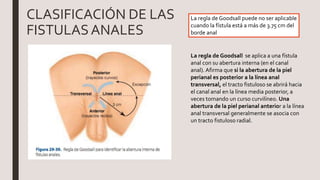 CLASIFICACIÓN DE LAS
FISTULASANALES
La regla de Goodsall puede no ser aplicable
cuando la fístula está a más de 3.75 cm del
borde anal
La regla de Goodsall se aplica a una fístula
anal con su abertura interna (en el canal
anal). Afirma que si la abertura de la piel
perianal es posterior a la línea anal
transversal, el tracto fistuloso se abrirá hacia
el canal anal en la línea media posterior, a
veces tomando un curso curvilíneo. Una
abertura de la piel perianal anterior a la línea
anal transversal generalmente se asocia con
un tracto fistuloso radial.
 