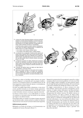 Técnicas quirúrgicas FISURA ANAL
página 3
El paciente se deja en decúbito supino durante un cuarto
de hora. Regresa a su domicilio por sus propios medios y
nosotros le aconsejamos limitar su actividad durante las 48
horas siguientes y tomar baños de asiento, y eventualmente
un analgésico la primera noche.
Si existe una papila hipertrófica voluminosa, o una excre-
cencia, pueden extraerse en el mismo tiempo operatorio.
Las consecuencias son habitualmente muy sencillas. A veces
se abre la herida, entonces curará por segunda intención.
Las fisuras crónicas tienen a veces dificultades en curarse;
en ocasiones es necesario avivar los bordes en las semanas
que siguen a la esfinterotomía.
Si una fisura debe ser tratada en el mismo tiempo operatorio
que las hemorroides, nuestra actitud es realizar la esfintero-
tomía interna en la zona de la hemorroidectomía izquierda.
Esfinterotomía posterior
Realizada en el lecho de la fisura, es la leiomiotomía con
anoplastia de Arnous, Parnaud y Denis [13
].
Después de anestesia local, locorregional o general, se coloca
una pinza sobre la excrecencia posterior y se corta con el bis-
turí un colgajo cutáneo triangular con base posterior, pasan-
do a lo largo del polo posterior de la fisura, de la excrecencia
y del trayecto fistuloso por debajo de la fisura, si éste existe.
El colgajo cutaneomucoso se diseca entonces de atrás
hacia delante, hasta la línea pectínea, denudando, sucesi-
vamente, el tejido celular subcutáneo, las fibras del fascí-
culo subcutáneo del esfínter externo, después las fibras
blanquecinas del esfínter interno. El esfínter interno se
secciona entonces, con tijera o bisturí, de abajo arriba,
hasta la línea pectínea, a nivel de la comisura posterior. Su
borde inferior es fácilmente distinguible de las fibras del
fascículo subcutáneo, y su cara externa del esfínter exter-
no propiamente dicho. Este tiempo de esfinterotomía es
llamado «leiomiotomía» por Arnous. Es cómodo y puede
ser todavía más fácil con la colocación de una valva o de
un separador en el canal anal. El esfínter interno se pone
así bajo tensión, se individualiza mejor y permite una
disección más fácil.
40-700
1 La fisura (con mayor frecuencia situada a nivel de la comisura
posterior), a menudo está acompañada, a nivel de la línea ano-
cutánea, de una excrecencia cutaneomucosa. Y, a nivel de la
línea pectínea, de una papila hipertrófica, llamada papila cen-
tinela o pólipo centinela. Se trata de un seudopólipo.
La línea de puntos muestra la incisión cutánea, inmediatamen-
te por fuera del reborde cutaneomucoso y la disección del
esfínter interno en su región infrapectínea:
— En el interior: entre mucosa y esfínter interno.
— En el exterior: entre esfínter interno y esfínter externo.
2 La colocación de un separador intraanal permite ejercer una
tensión sobre el esfínter interno que se hace entonces perfec-
tamente perceptible, igual que la depresión que lo separa del
esfínter externo. Se puede trazar así, sin error, la línea de inci-
sión que debe quedar sobre la vertiente cutánea y que puede
ser de 1 cm o más.
3 La disección se practica con tijeras, después de la inyección
de suero con adrenalina. La disección, por dentro del esfínter
interno, pasa a ras del esfínter para no dañar las venas de la
submucosa. Por fuera, el espacio se identifica fácilmente, gra-
cias al dilatador.
4 La sección del esfínter interno se realiza con tijera hasta la
línea pectínea, y nunca por encima.
5 Cierre de la incisión cutánea con dos puntos de hilo reabsor-
bible. El separador se retira y se realiza una compresión
manual introduciendo un dedo en el canal anal, dejándolo allí
de 2 a 3 minutos, para obtener una buena hemostasia y evitar
así un hematoma.
1 2 3
4 5
 