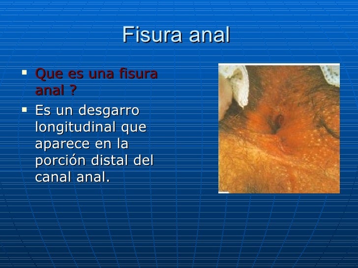 Fisura Anal